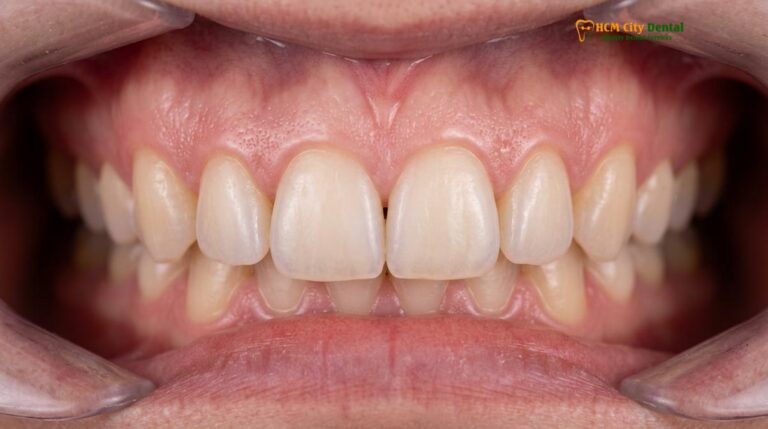 Bone Graft & Gum Graft for Full Mouth Rehabilitation: Clinical Guide