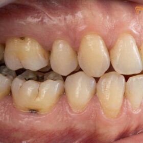 Bite Collapse Treatment: Restoring Vertical Dimension & Function