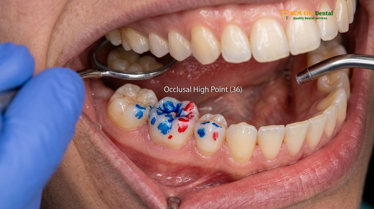 Clinical photography related to Bite Analysis for TMJ Saigon