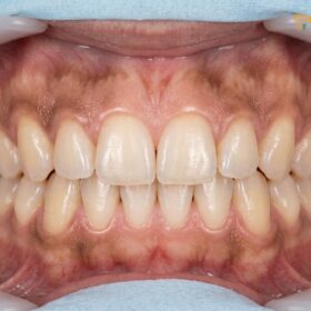 Black Gums Causes & Clinical Treatments | HCMC Dental