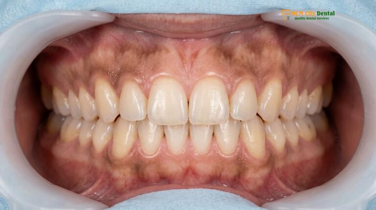 Black Gums Causes & Clinical Treatments | HCMC Dental