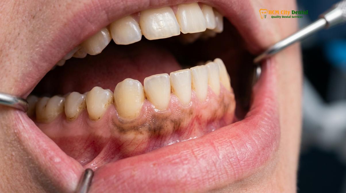 Clinical photography related to black gums causes