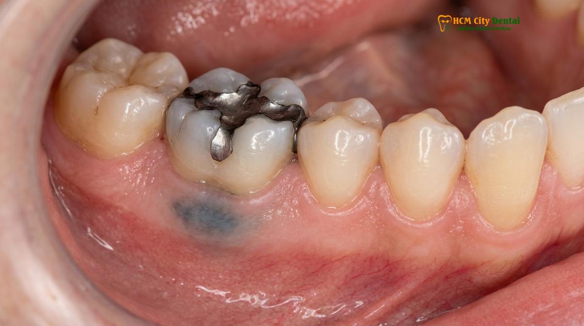 Visual description of black gums causes