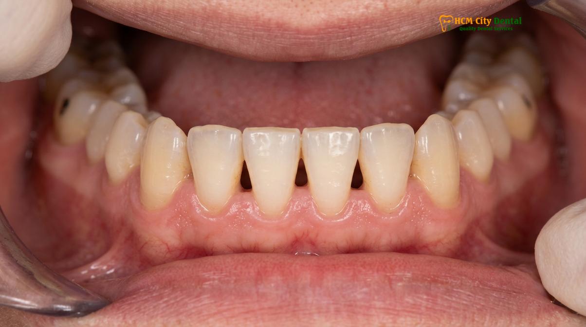 Clinical photography related to black triangle teeth