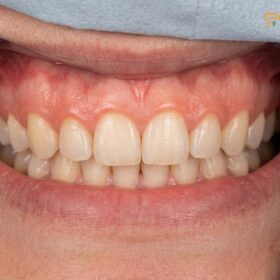 Gummy Smile Botox in Vietnam: Clinical Guide & Treatment Comparison