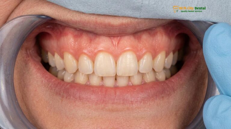 Gummy Smile Botox in Vietnam: Clinical Guide & Treatment Comparison