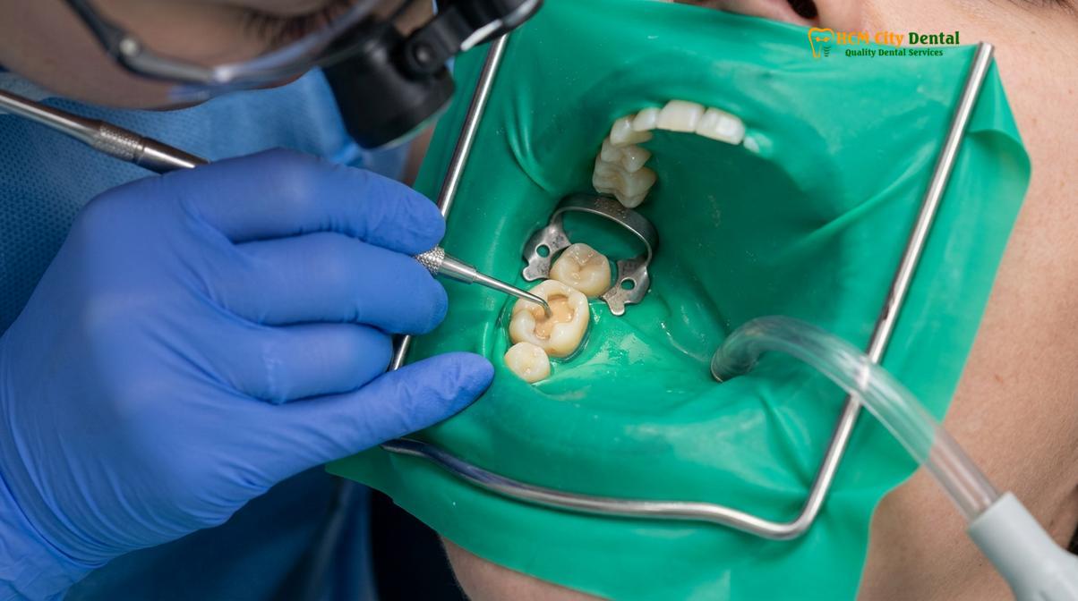 Clinical photography related to BPA free composite fillings