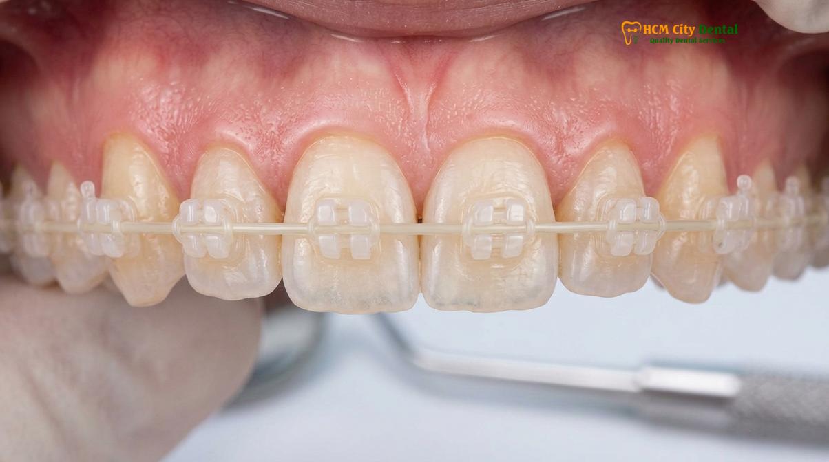 Clinical photography related to braces cost vietnam
