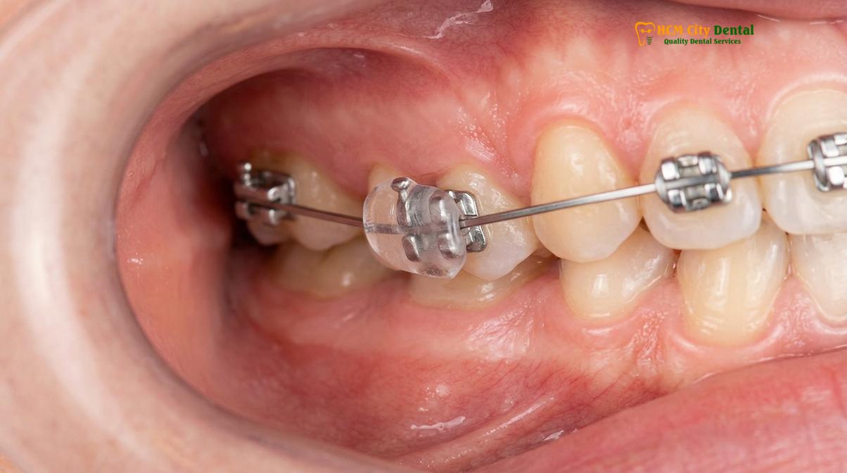 Visual description of dental kit for braces