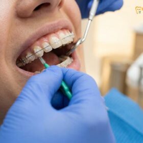How to Keep Teeth White With Braces: Clinical Guide | HCMC Dental