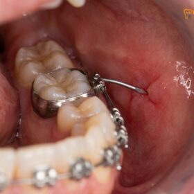 Fix Broken Braces Wire Vietnam | HCMC Dental