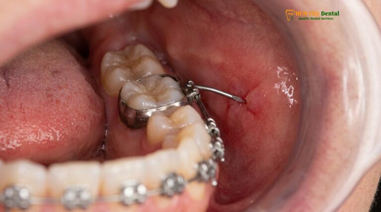 Fix Broken Braces Wire Vietnam | HCMC Dental