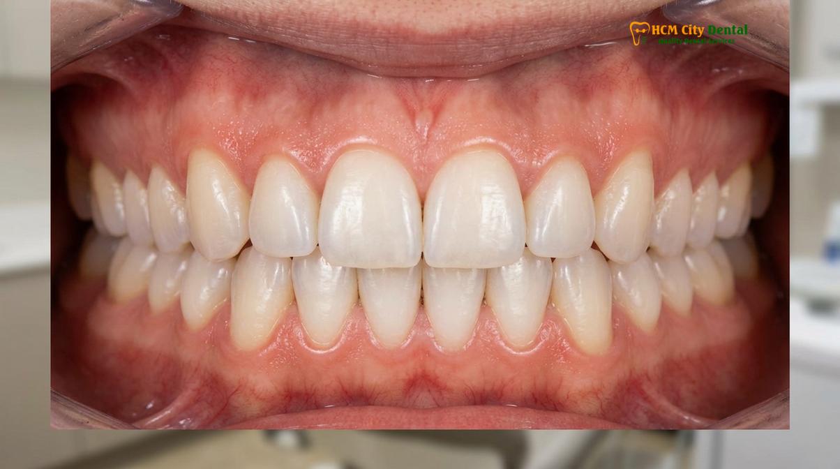 Clinical photography related to brushing your teeth with coconut oil and baking soda