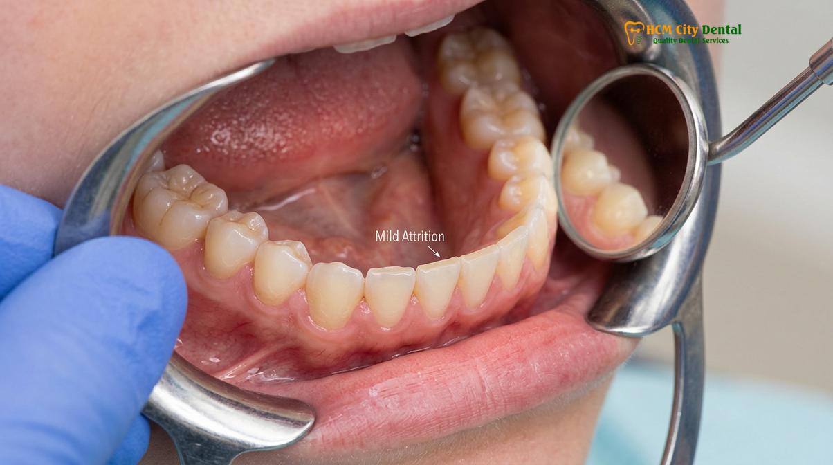 Visual description of bruxism in children teens