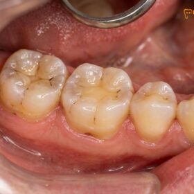 Bruxism Effects on Teeth: Clinical Damage & Treatments | HCMC Dental