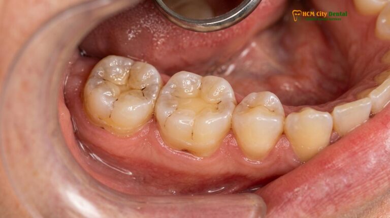 Bruxism Effects on Teeth: Clinical Damage & Treatments | HCMC Dental