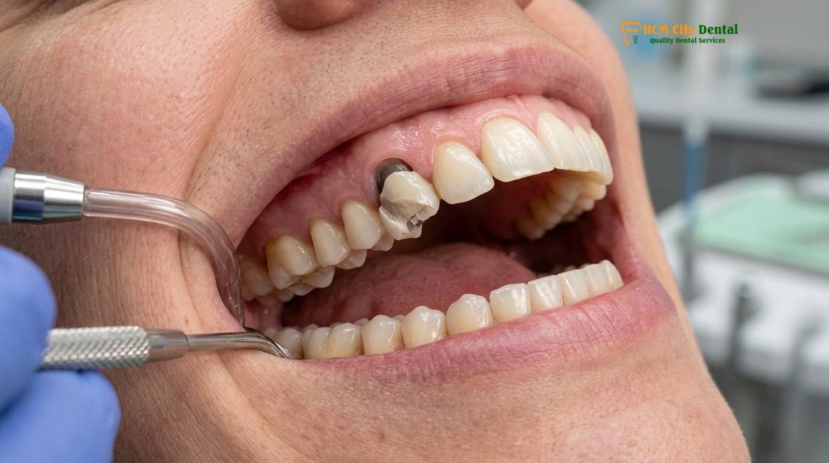 Visual description of bruxism effects on teeth