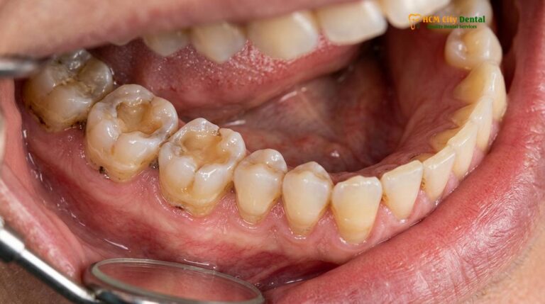 Bruxism Symptoms & Warning Signs: Clinical Guide | HCMC Dental