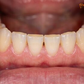 Bruxism Symptoms and Signs: A Clinical Guide | HCMC Dental