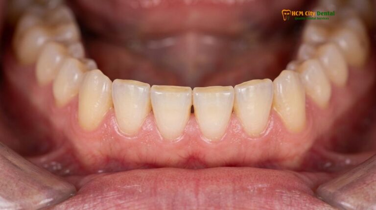 Bruxism Symptoms and Signs: A Clinical Guide | HCMC Dental