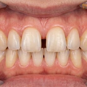 Can You Close Teeth Gap Without Braces? | HCMC Dental