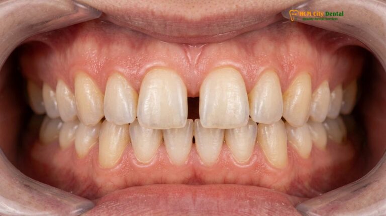 Can You Close Teeth Gap Without Braces? | HCMC Dental