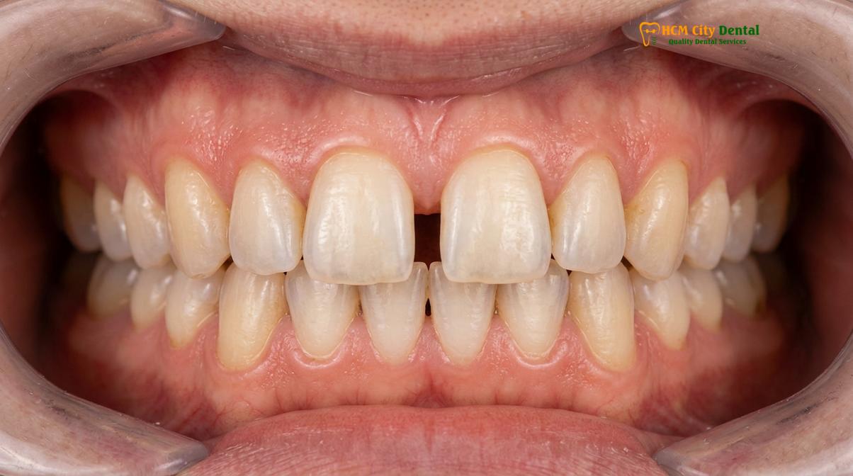 Clinical illustration of Can You Close Teeth Gap Without Braces