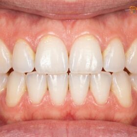 Can You Eat After Dental Cleaning? Clinical Diet & Care Guide
