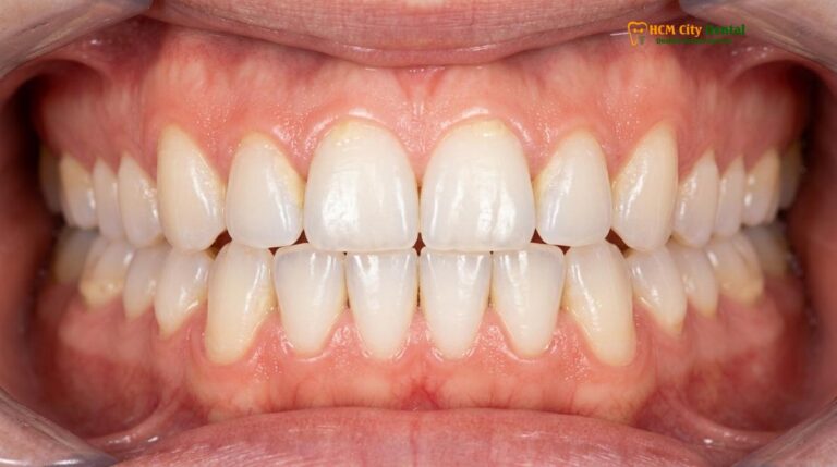 Can You Eat After Dental Cleaning? Clinical Diet & Care Guide