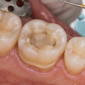 Overlay After Root Canal: A Conservative Alternative to Full Crowns