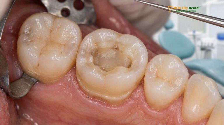 Overlay After Root Canal: A Conservative Alternative to Full Crowns