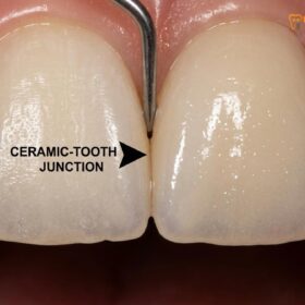 Can You Whiten Fillings, Crowns, and Veneers? Clinical Guide