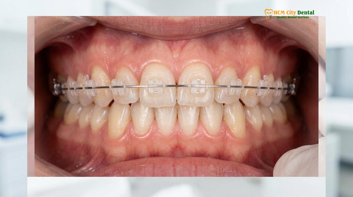Visual description of ceramic braces vs metal braces aesthetics
