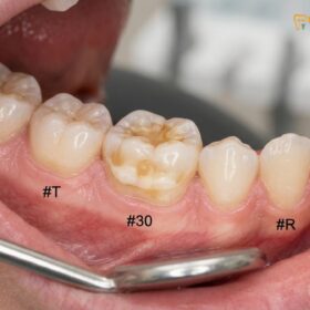 Chalky Teeth in Kids (MIH): Causes, Symptoms & Clinical Treatment