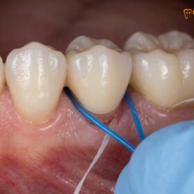 How to Clean Under a Dental Bridge: Clinical Guide & Tools