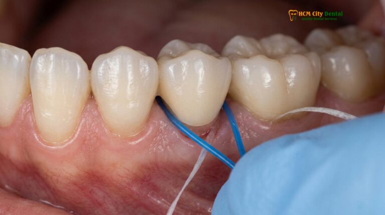 How to Clean Under a Dental Bridge: Clinical Guide & Tools