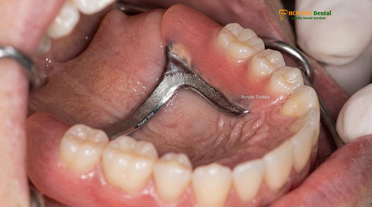 Clinical photography related to Cast Metal Dentures