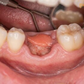 Complications After Tooth Extraction: Clinical Guide | HCMC Dental