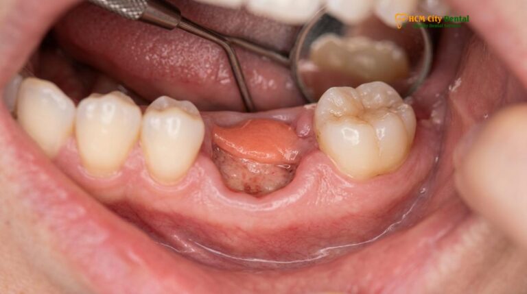Complications After Tooth Extraction: Clinical Guide | HCMC Dental