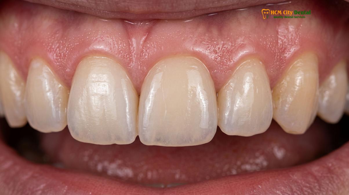 Clinical photography related to composite veneers cost vietnam