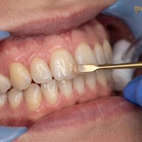 Composite Veneers Same Day: Clinical Guide & Procedure
