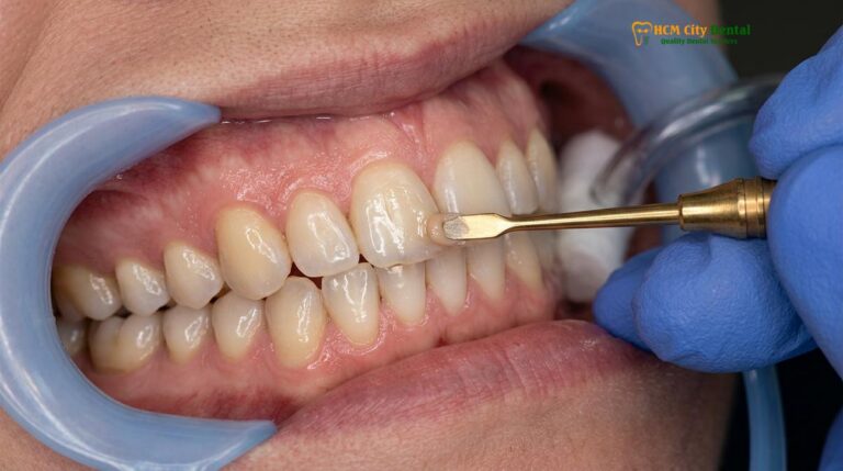 Composite Veneers Same Day: Clinical Guide & Procedure