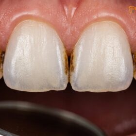 Cosmetic Teeth Cleaning for Coffee Stains Removal: Clinical Guide