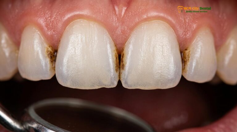 Cosmetic Teeth Cleaning for Coffee Stains Removal: Clinical Guide