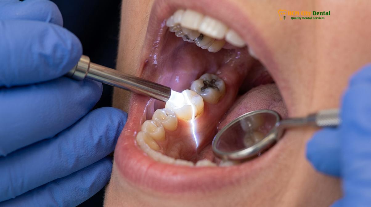 Clinical photography related to cracked tooth pain when biting