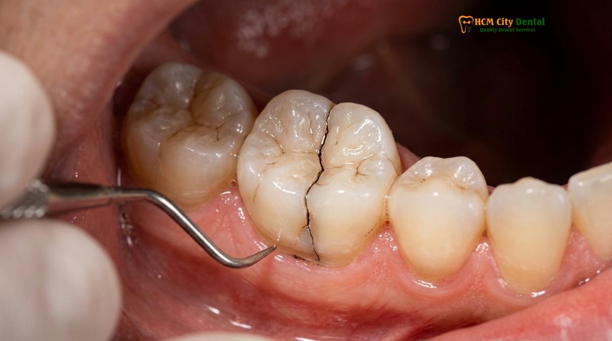 Visual illustration of Cracked Tooth Root Canal