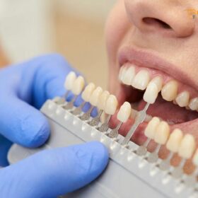Color Matching Dental Inlays: Clinical Shade Selection & Aesthetics