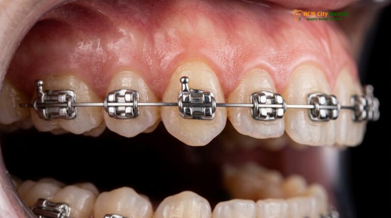 Damon System Braces Cost: Clinical Guide & Pricing | HCMC Dental