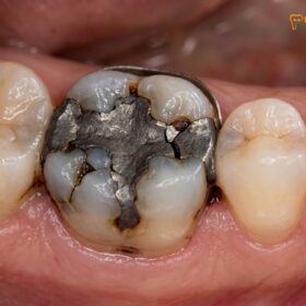 Replace Failing Fillings with Onlay: A Clinical Guide to Ceramic Restorations