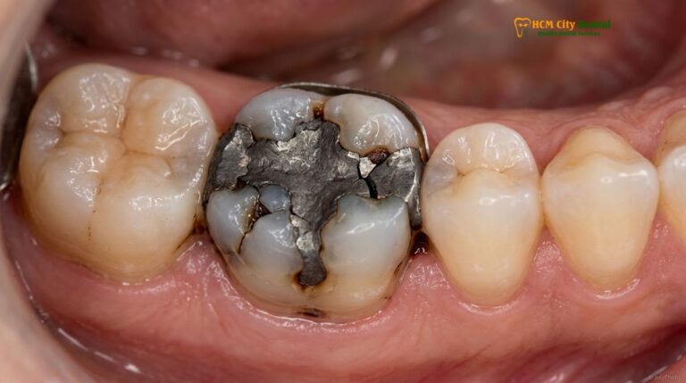 Replace Failing Fillings with Onlay: A Clinical Guide to Ceramic Restorations
